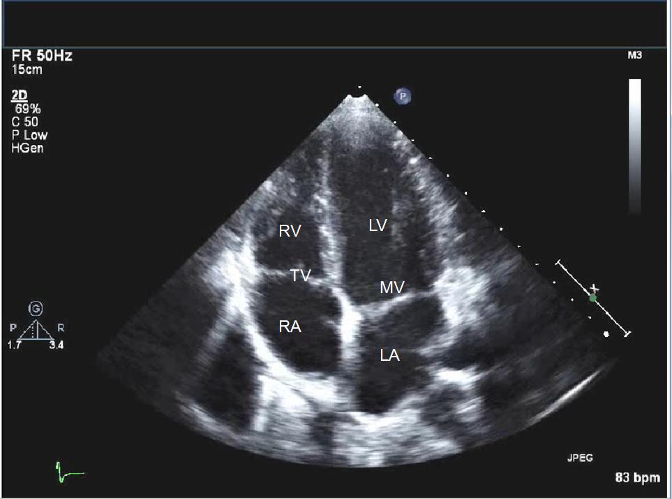 echocardiography