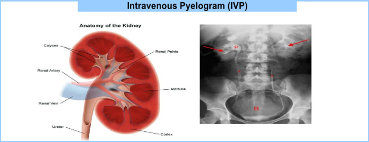 IVP